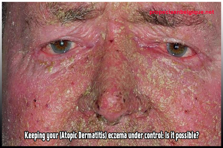 Traiter La Dermatite